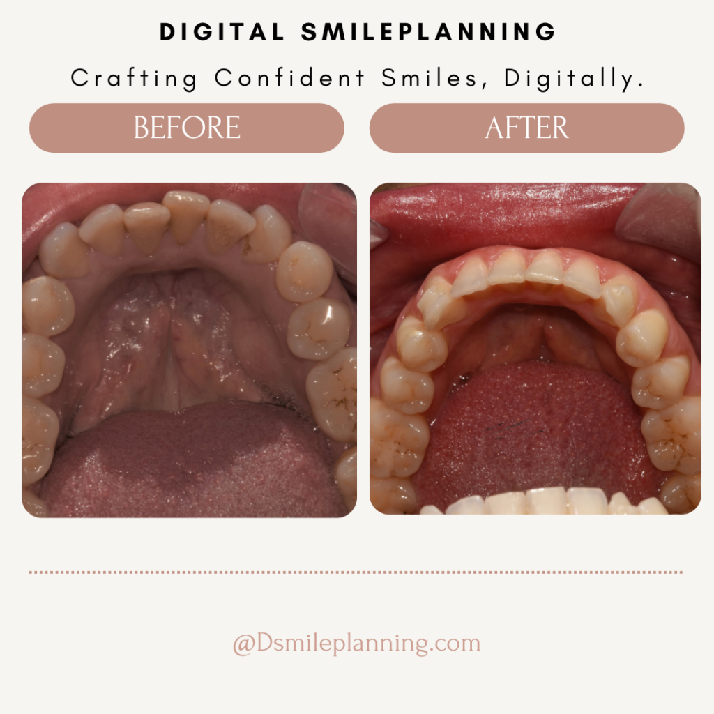 Digital smile planning