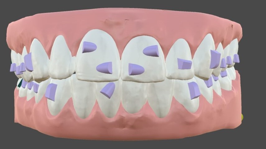 Teeth2