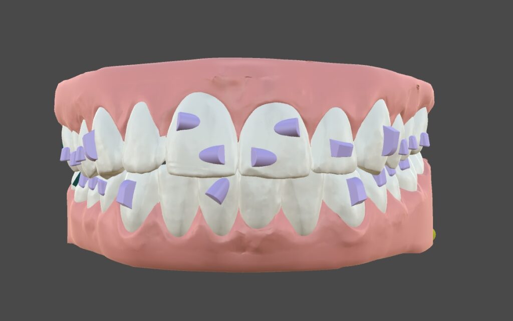 Teeth3