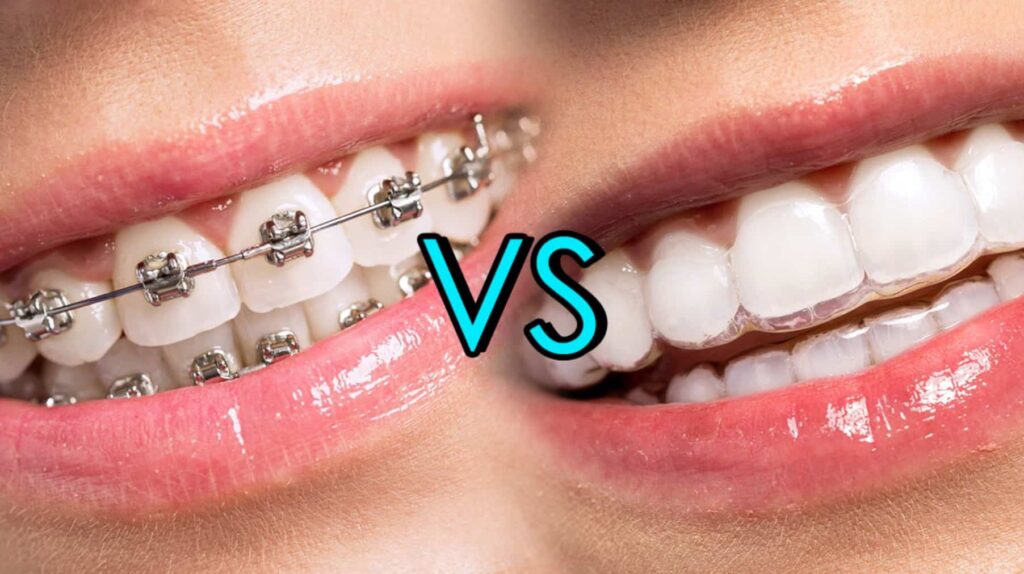 Braces vs invisalignclear