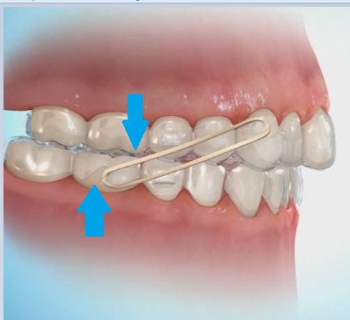 Invisalign c11 2